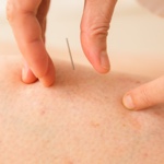 Acupuncture Services