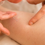 Acupuncture Services