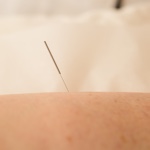 Acupuncture Services